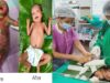 अत्यंत दुर्लभ बीमारी से जूझ रहे नवजात को बीजापुर जिला अस्पताल की SNCU में मिला नया जीवन