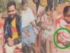 पत्थर शरीर वाली बच्ची के उपचार को लेकर बाल आयोग सक्रिय