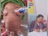 लोहरसी आयुर्वेदिक औषधालय में दर्द प्रबंधन हेतु कपिंग थेरेपी एवं विशेष आयुर्वेदिक उपचार सेवाओं का आरंभ
