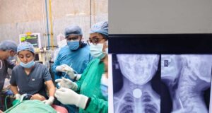 6 वर्षीय मासूम की आहार नली से सफलतापूर्वक निकाला गया सिक्का, बची जान